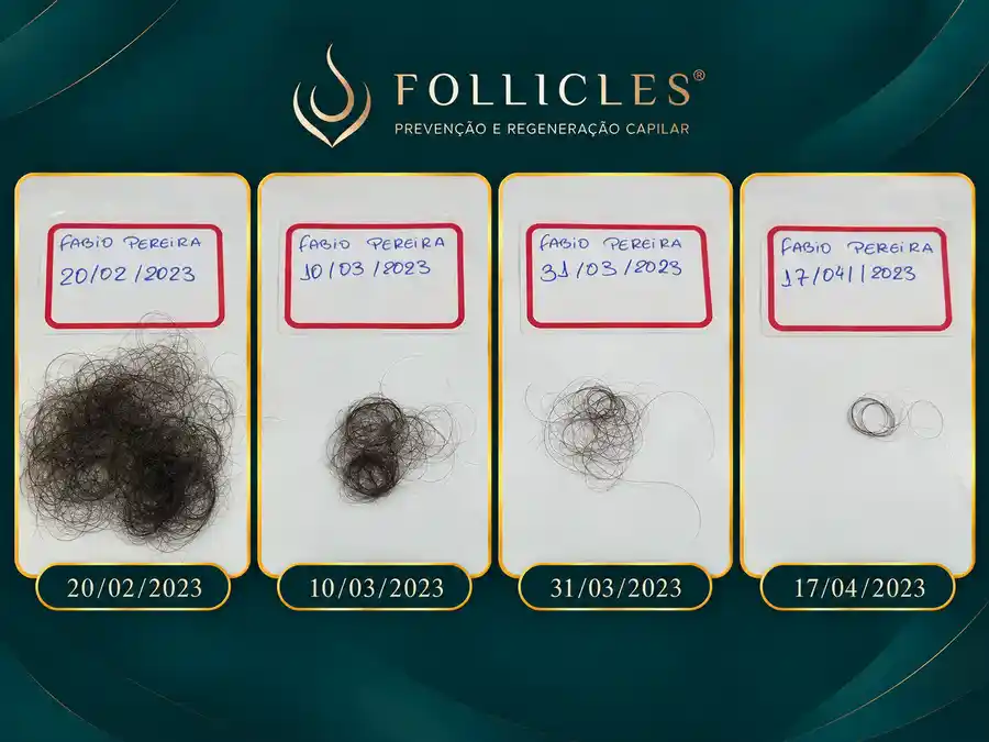 Resultado de queda capilar — paciente da Clínica Follicles, imagem 2